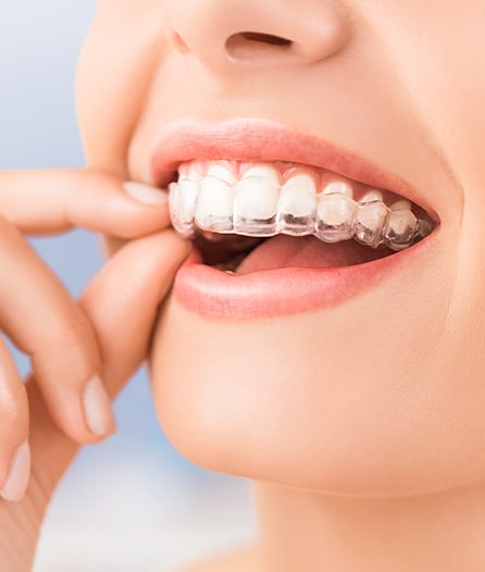 Invisalign in New Westminster, BC - Frequently Asked Questions About  Invisalign