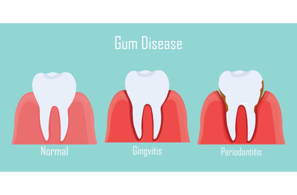 Illustration of gum disease progression showing a healthy tooth, gingivitis, and advanced periodontitis.