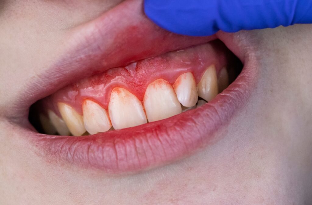 Close-up of a patient’s mouth with red, swollen gums showing signs of gingivitis during a dental exam.