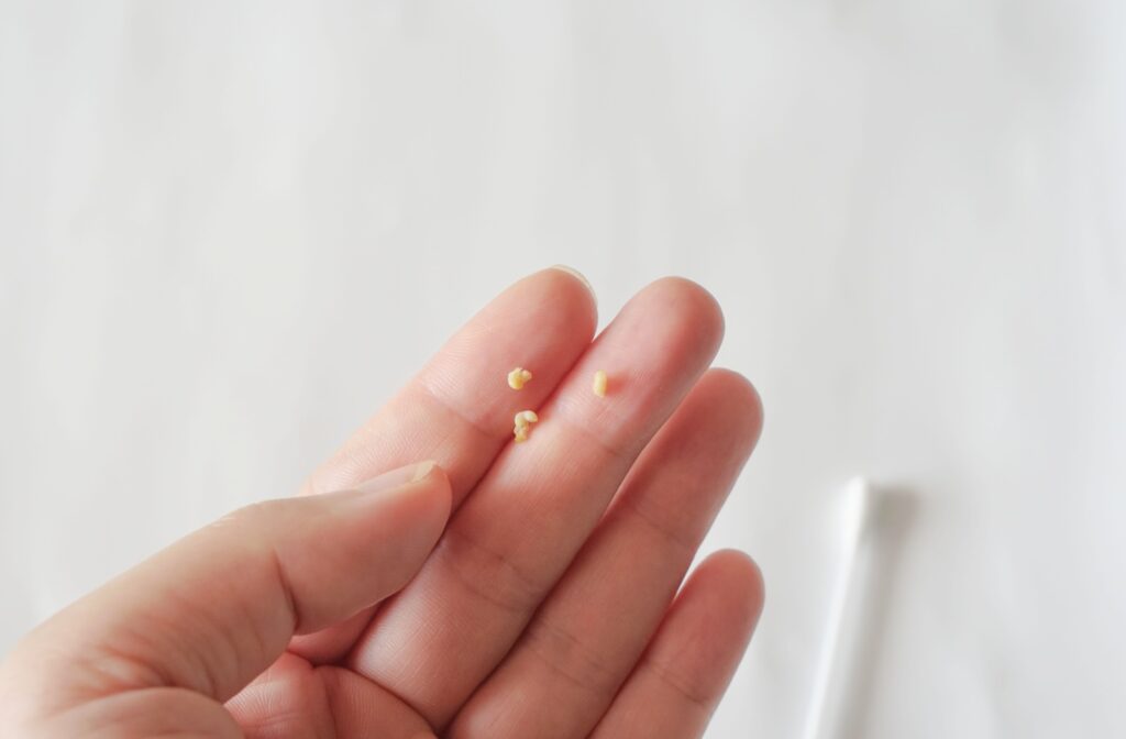 Hand holding three small yellowish tonsil stones removed from the throat.