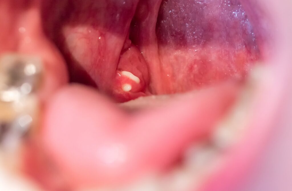 Close-up of a tonsil with a visible white tonsil stone lodged in the tissue.