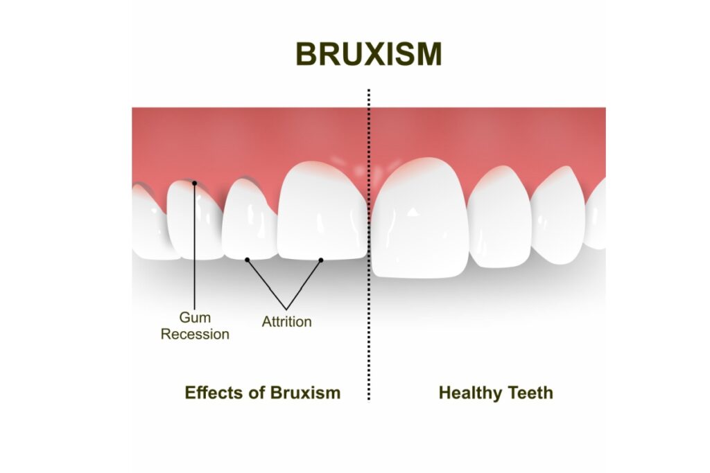 Bruxism comparison vs healthy teeth showing gum recession and attrition.