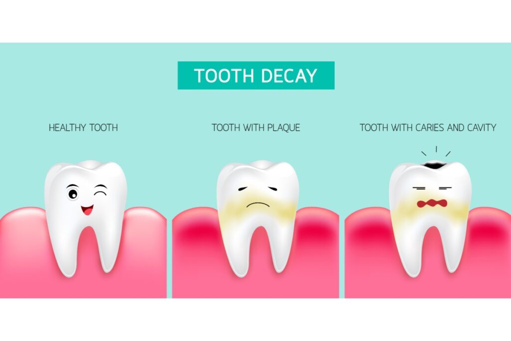 Illustrated diagram of healthy tooth, tooth with plaque, and tooth with caries and cavity.