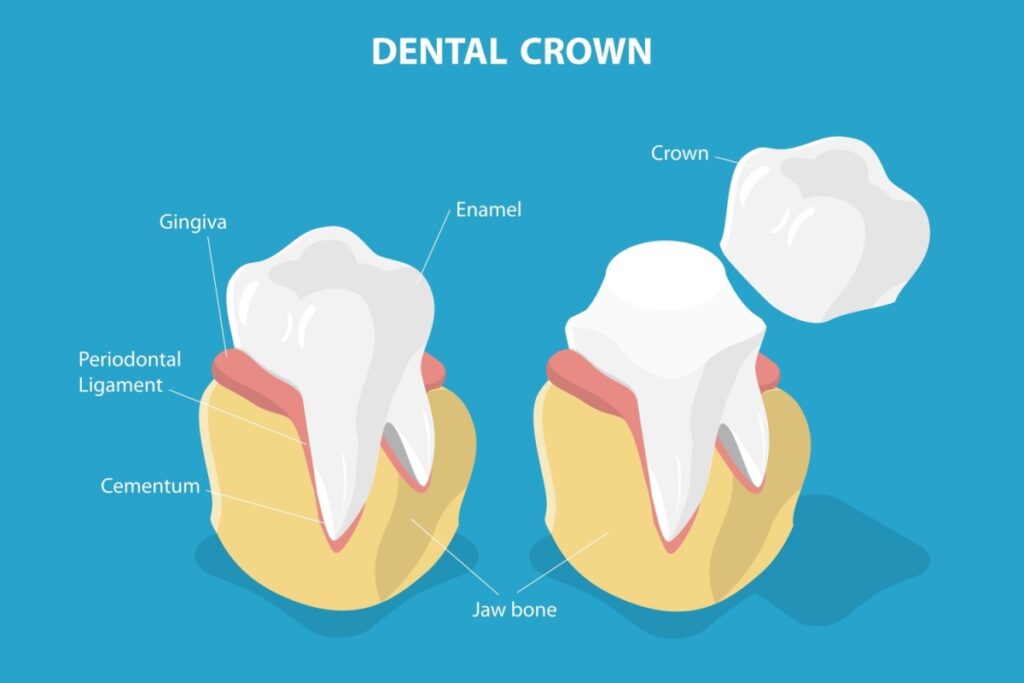 Educational dental diagram showing the anatomy of a natural tooth on the left with labeled components (crown, enamel, gingiva, periodontal ligament, cementum, jaw bone) next to a tooth restored with a dental crown on the right, demonstrating how a crown caps the entire visible portion of the tooth.