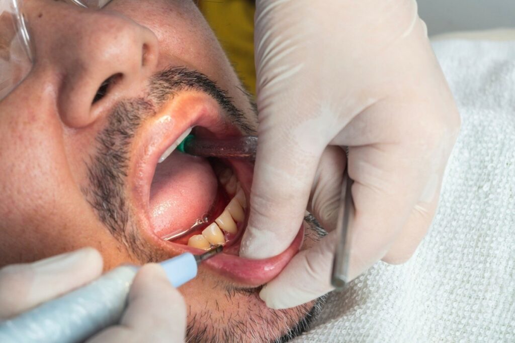 A close-up shot of a patient receiving a professional dental procedure. A dentist in white gloves uses a specialized tool on the lower teeth, while a suction tube is used to clear the area.