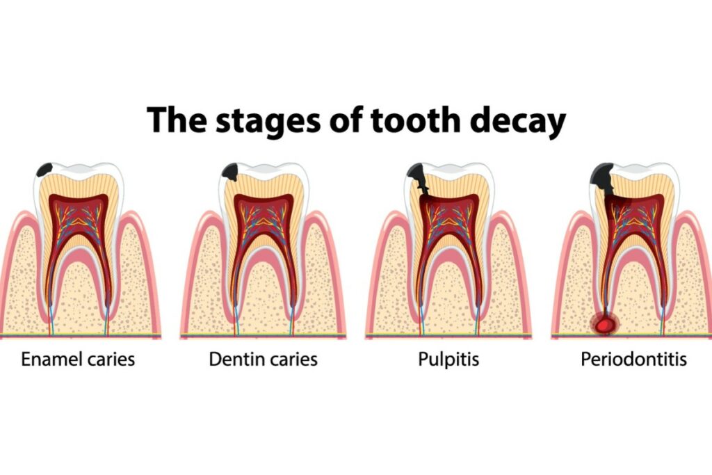 A diagram titled 'The stages of tooth decay' showing four cross-sections of a tooth. From left to right: 'Enamel caries' shows decay in the outer layer; 'Dentin caries' shows decay reaching the middle layer; 'Pulpitis' shows decay reaching the inner pulp; and 'Periodontitis' shows extensive decay and a red abscess at the root tip.