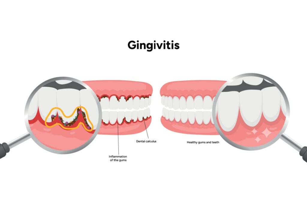 Gingivitis healthy vs inflamed gums illustration.